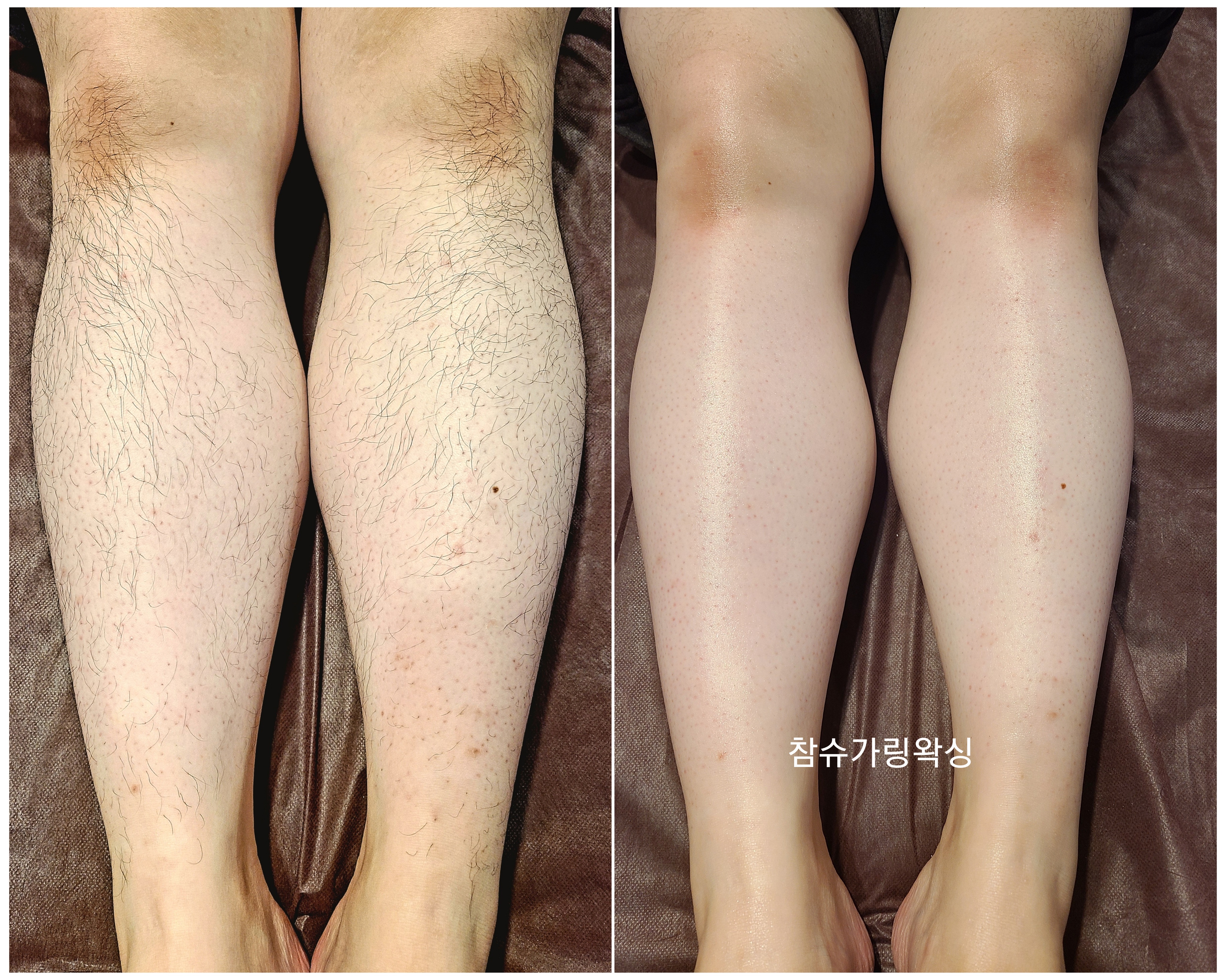 참슈가링왁싱