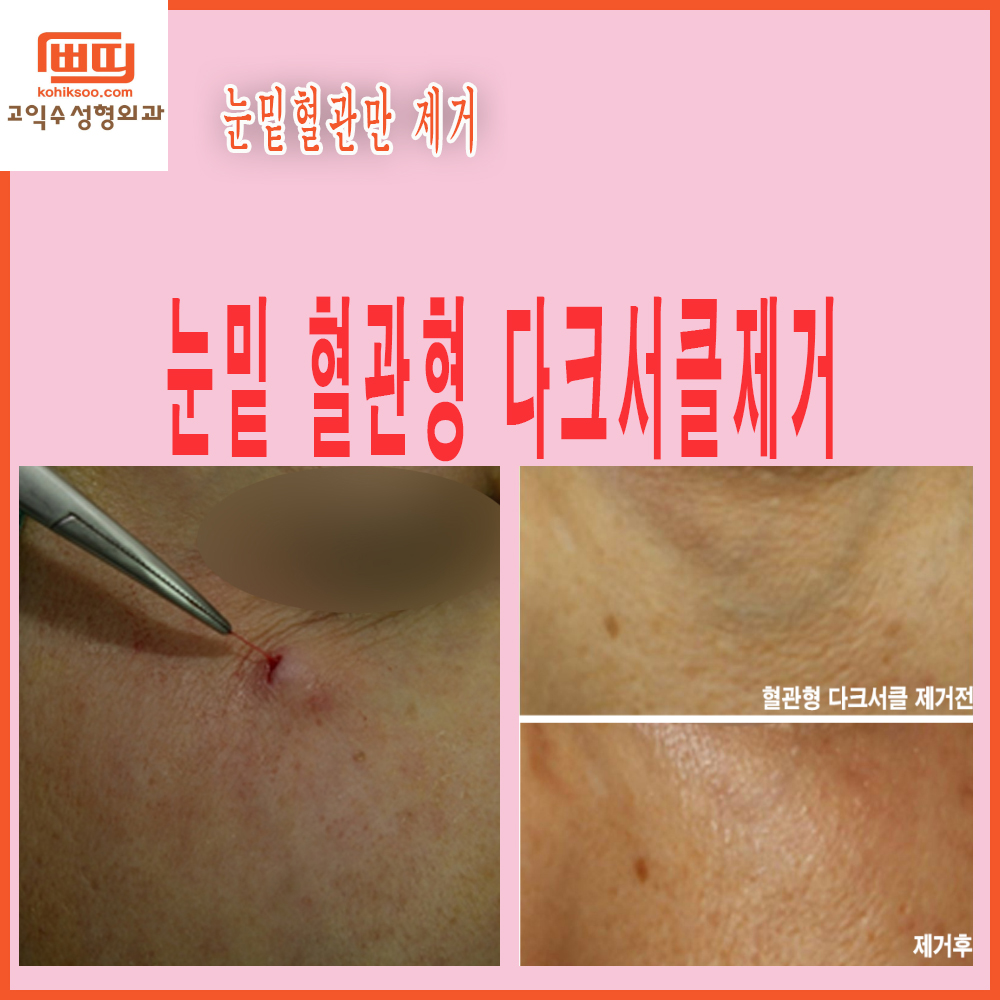 고익수성형외과의원 시술 전후 이미지