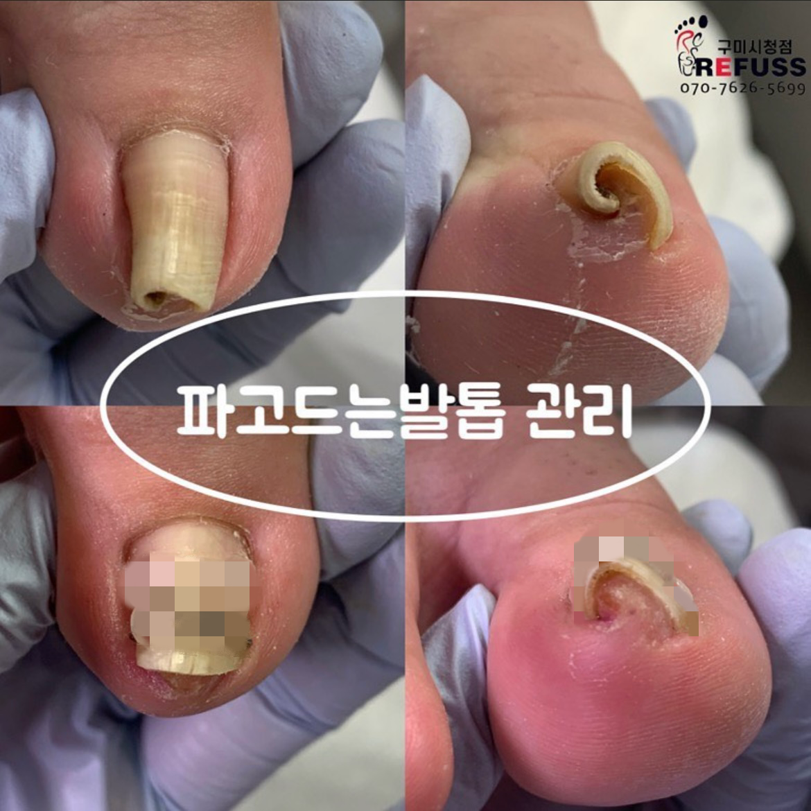 레푸스 구미시청점 내성발톱 발톱무좀 발각질