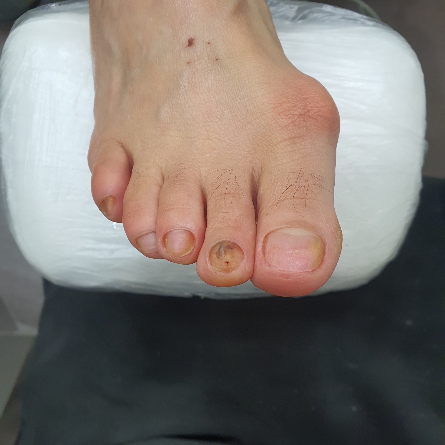 네일샵에스 아를솔즈 내성발톱 무좀 발각질 네일 문제성발