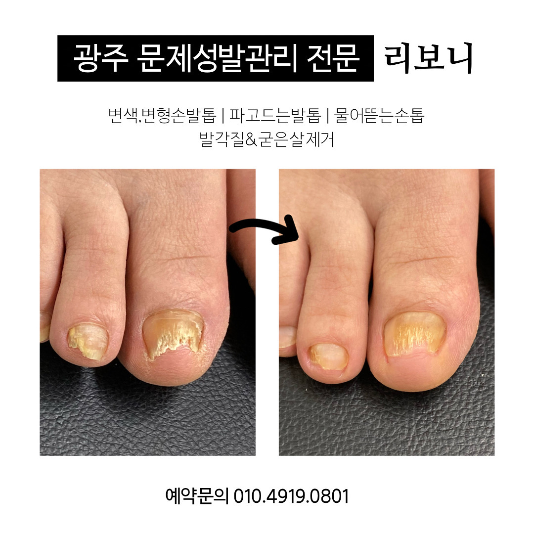 리보니 오로지푸스 무좀 내성발톱 발각질