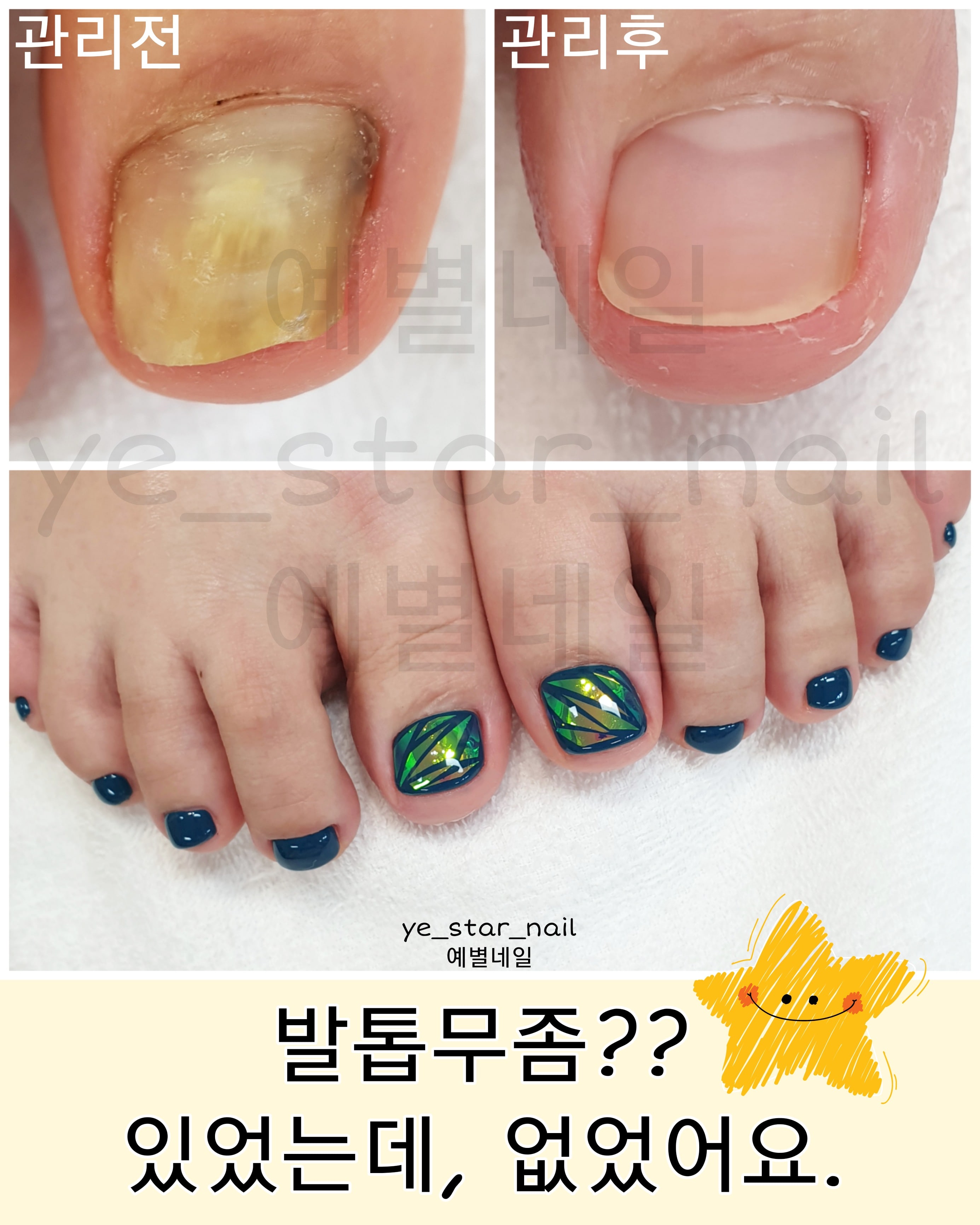 예별네일_젤네일 발톱무좀 내성발톱 물어뜯는손톱 손톱변형 대표 이미지