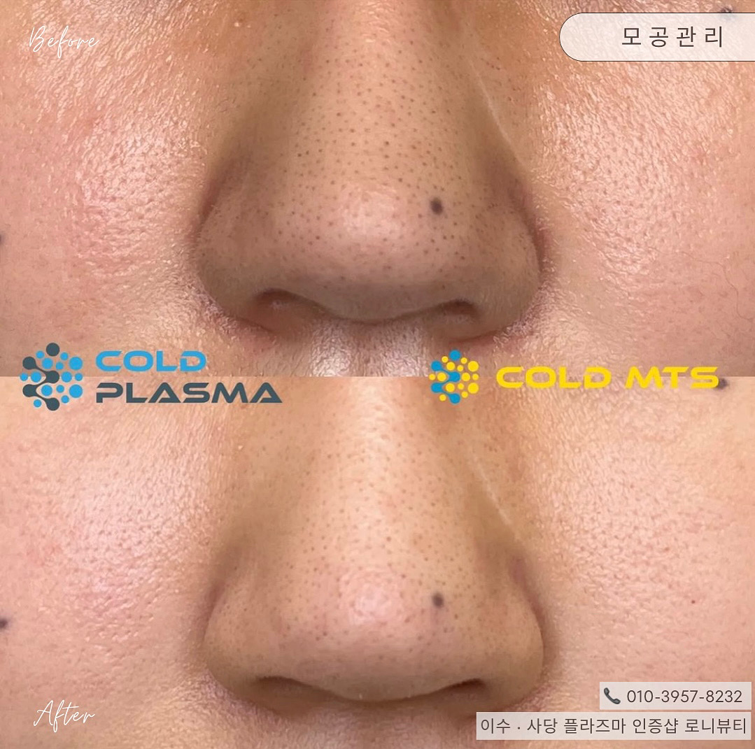 로니뷰티 플라즈마블라스트&에스테틱