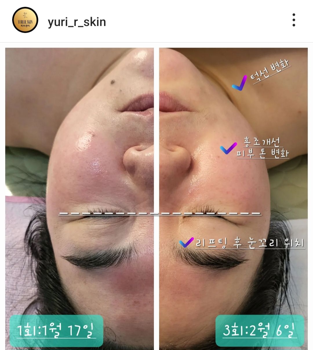 유리알스킨 대표 이미지