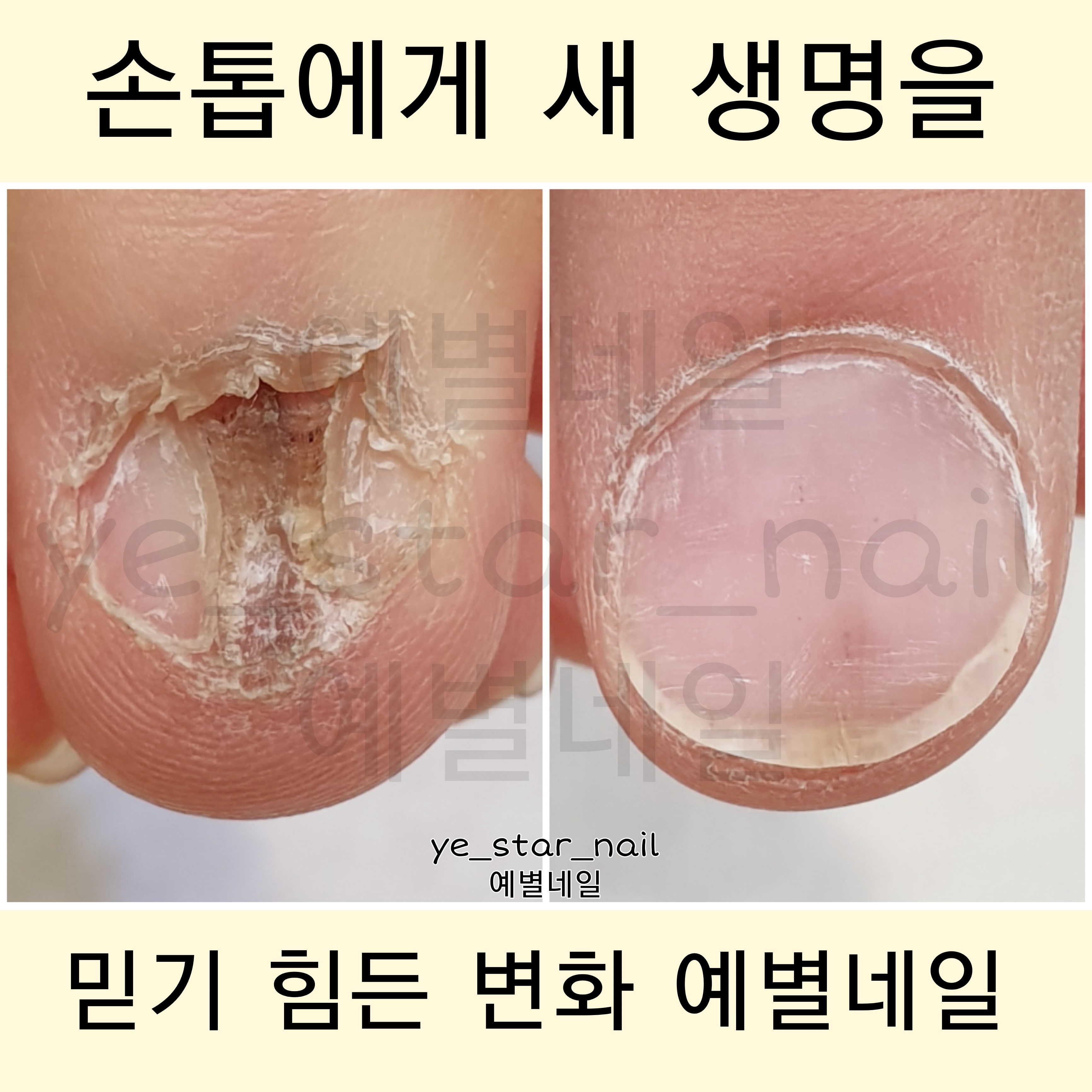 예별네일_젤네일 발톱무좀 내성발톱 물어뜯는손톱 손톱변형 대표 이미지