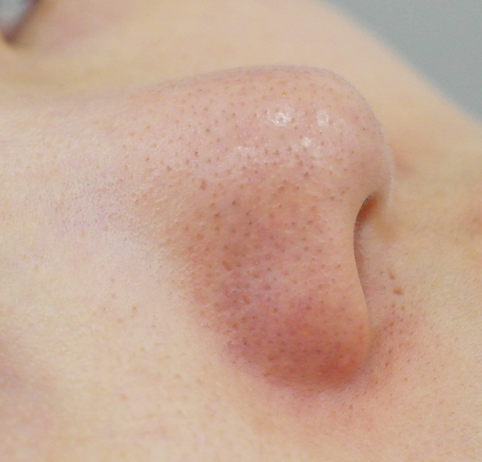 블랙헤드 코피다 대표 이미지