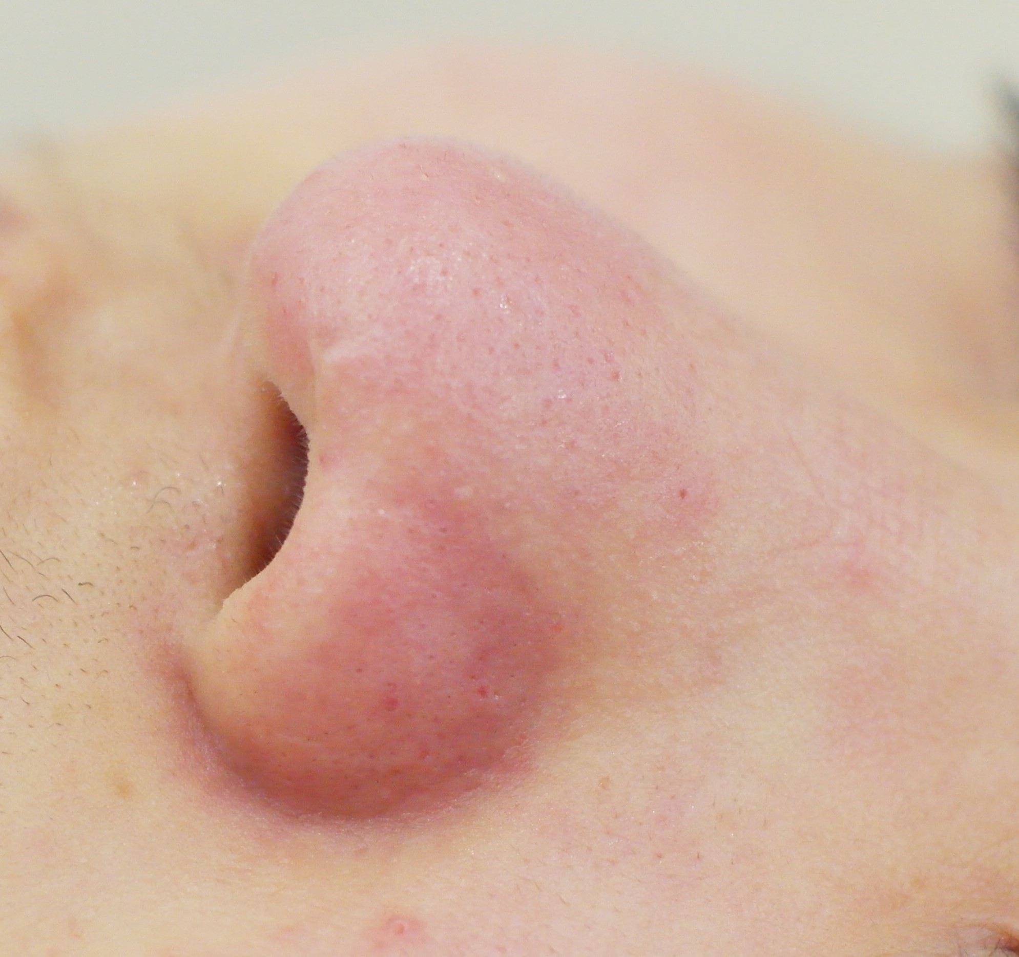 블랙헤드 코피다 대표 이미지