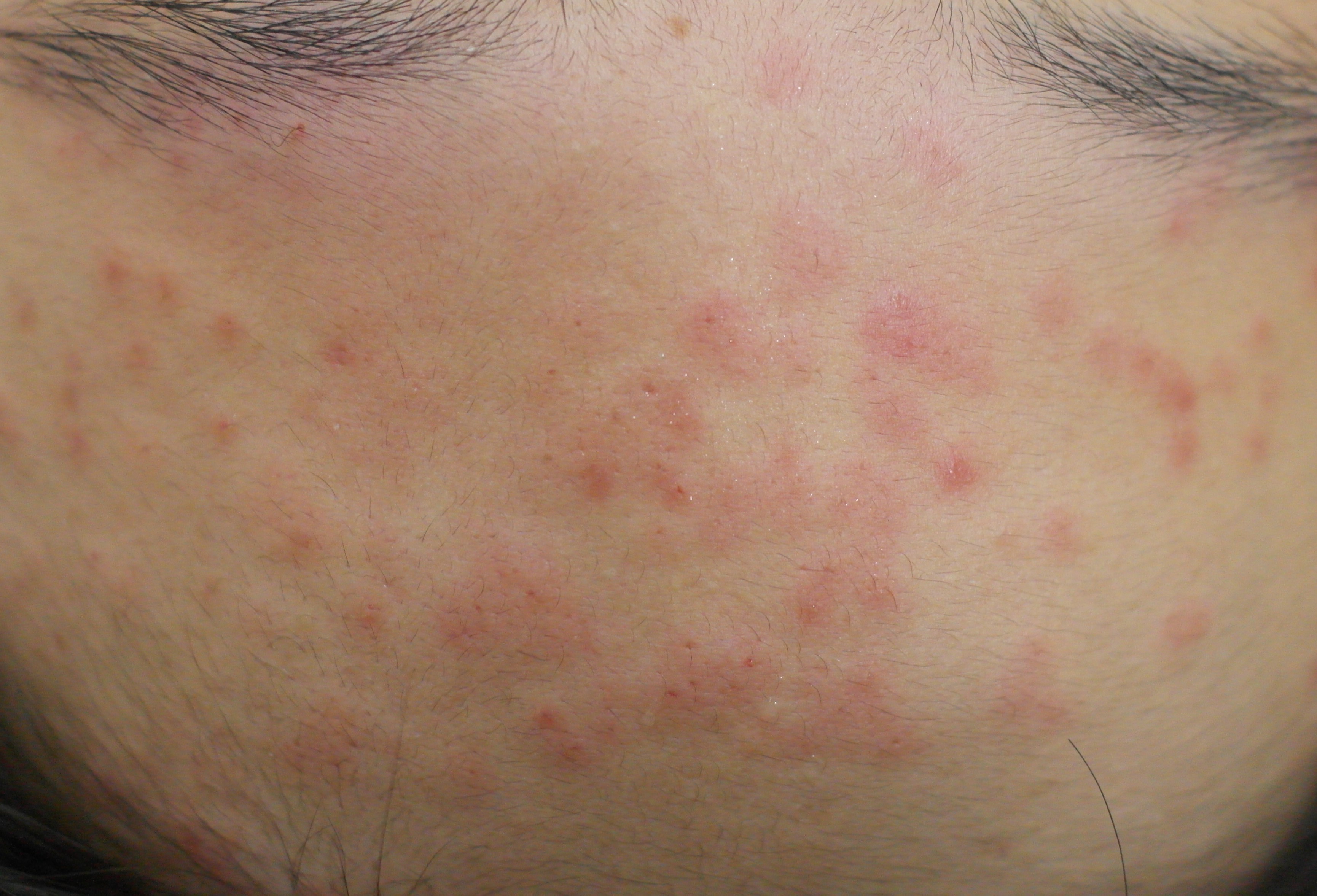 블랙헤드 코피다 대표 이미지