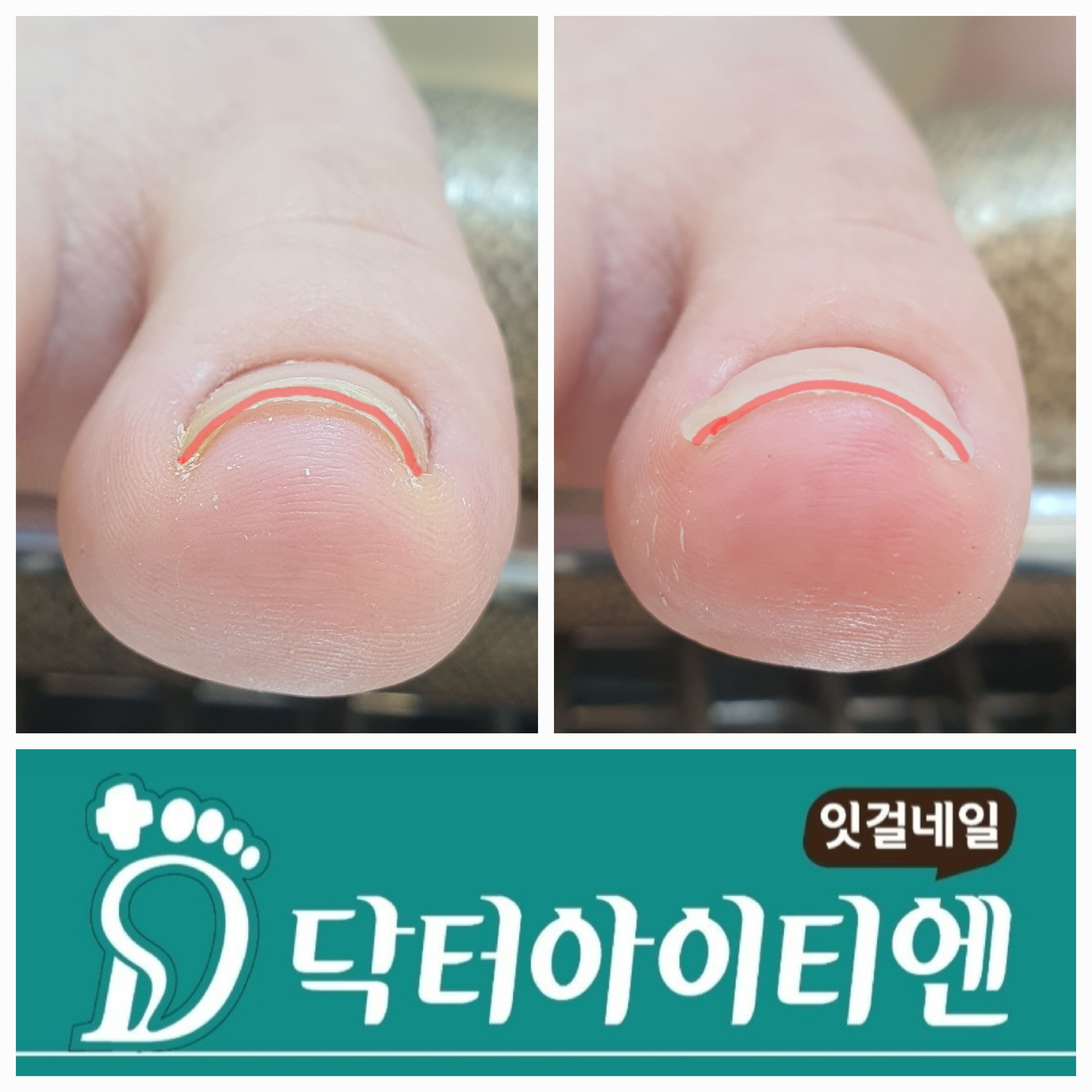 잇걸페디_내성무좀각질