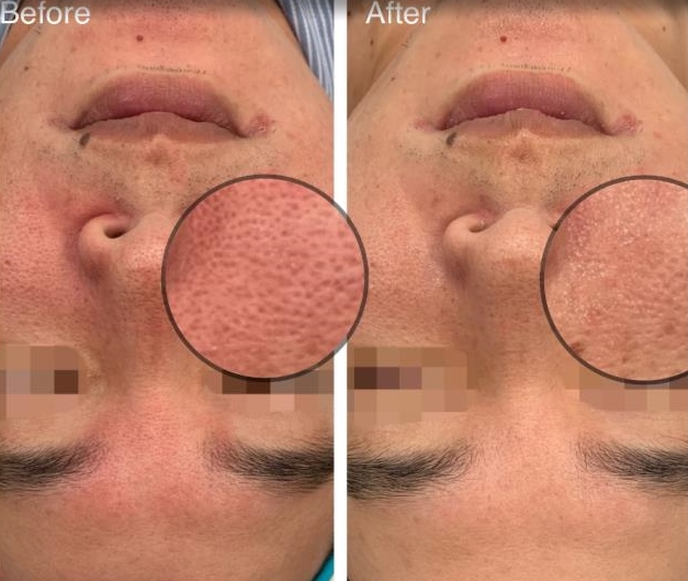 메이유스킨 여드름 압출 전후 사진