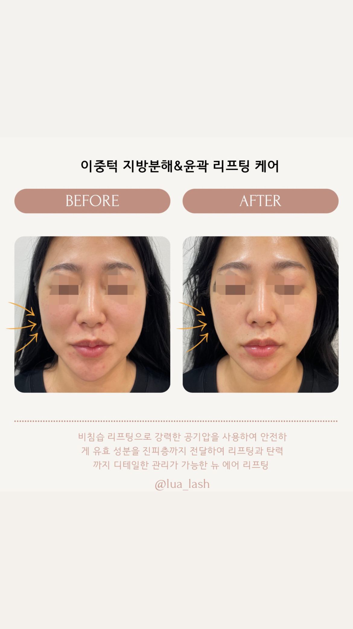 루아뷰티 & 에어바디 & 윤곽성형 리프팅