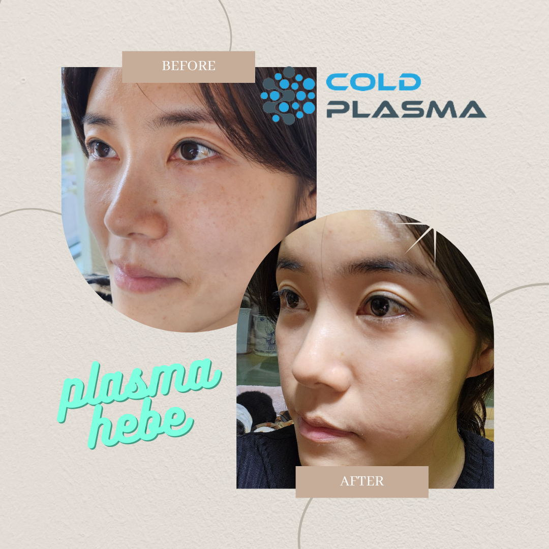 플라즈마헤베 울산본점
