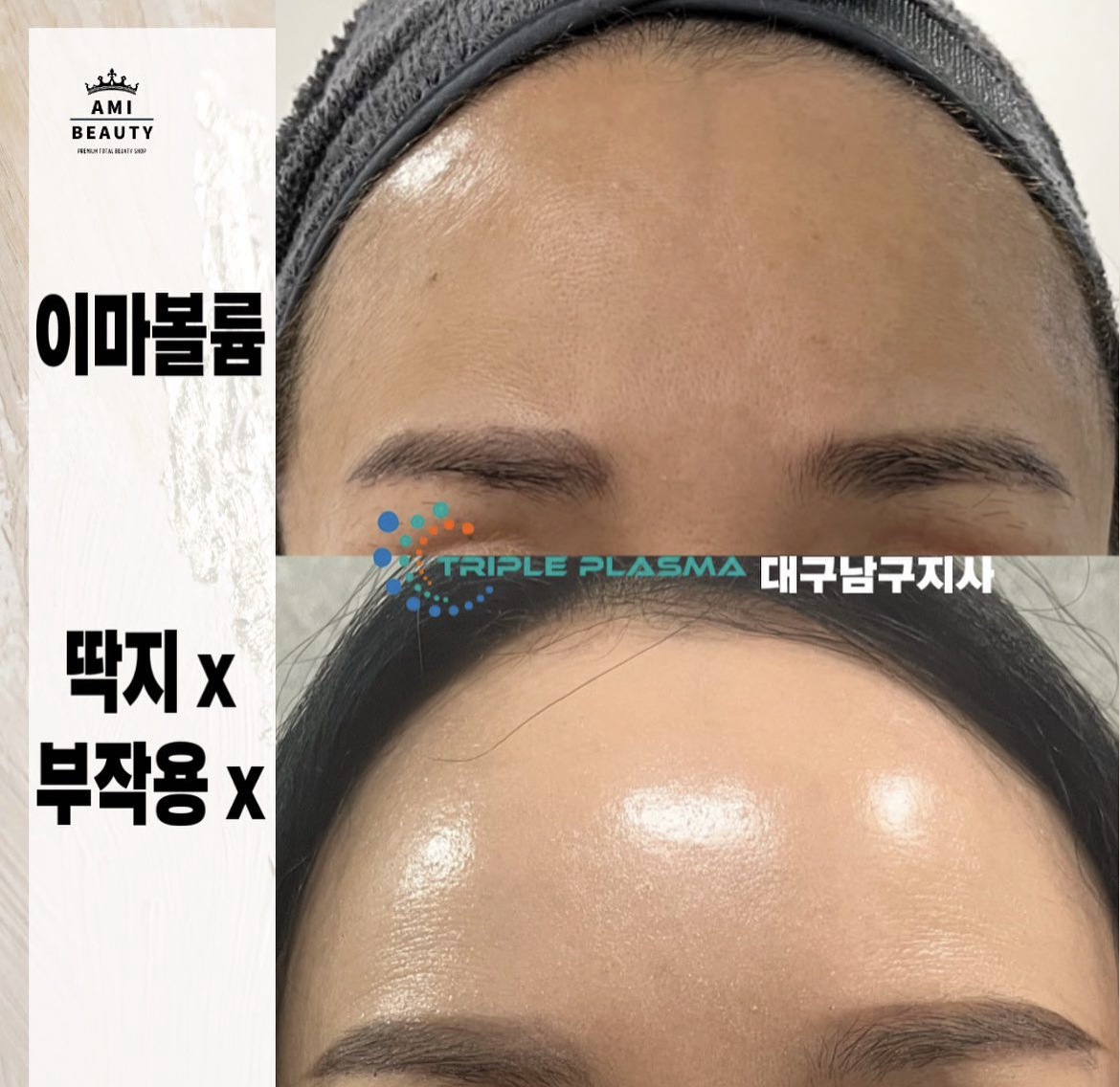콜드플라즈마지사 아미뷰티 아카데미