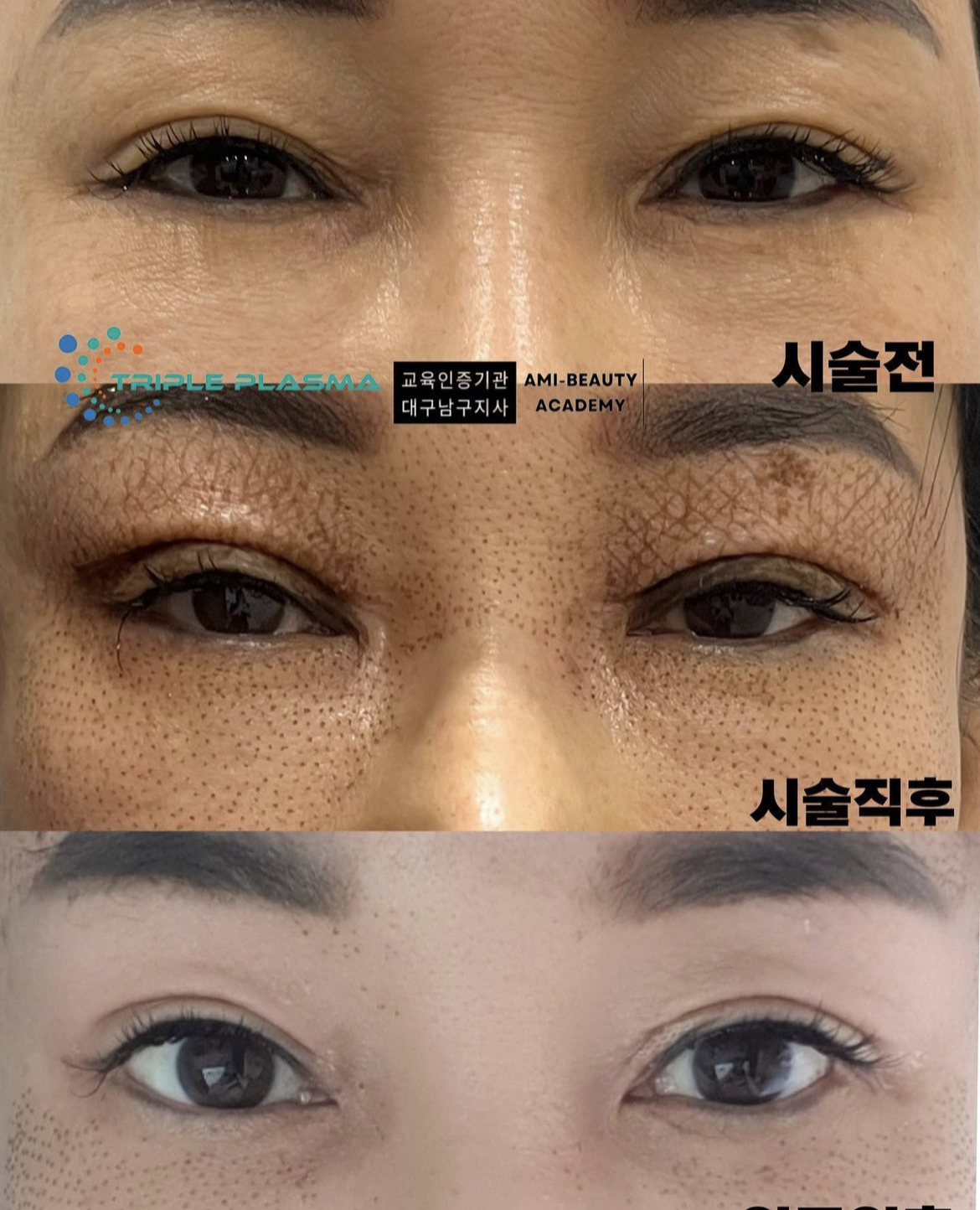 콜드플라즈마지사 아미뷰티 아카데미