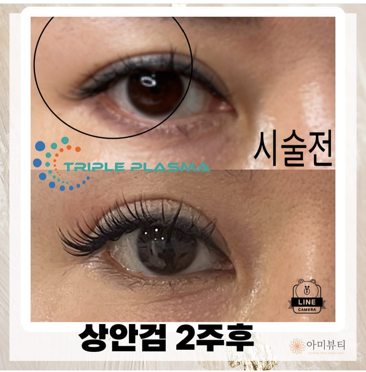 콜드플라즈마지사 아미뷰티 아카데미