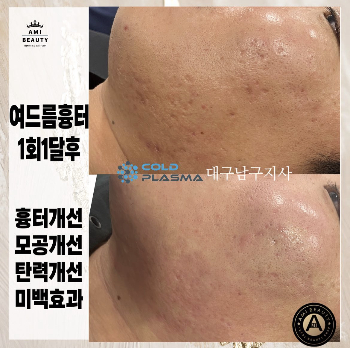 콜드플라즈마지사 아미뷰티 아카데미