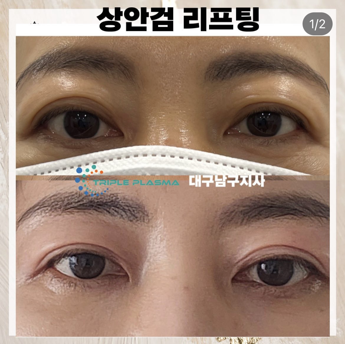 콜드플라즈마지사 아미뷰티 아카데미