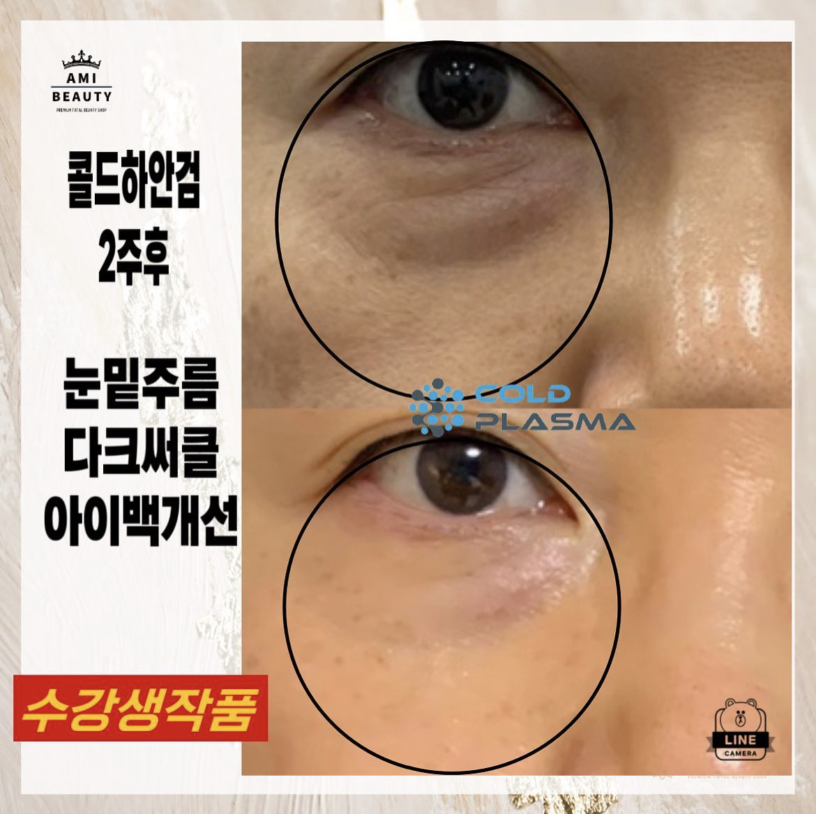 콜드플라즈마지사 아미뷰티 아카데미