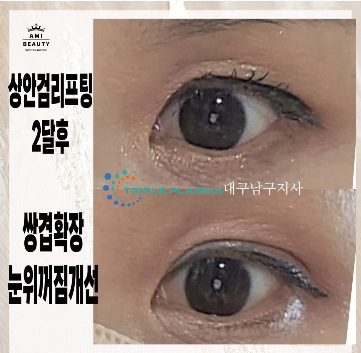 콜드플라즈마지사 아미뷰티 아카데미