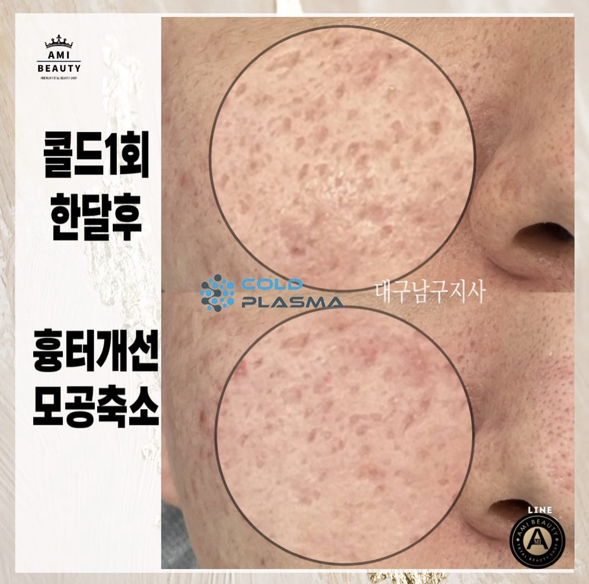 콜드플라즈마지사 아미뷰티 아카데미