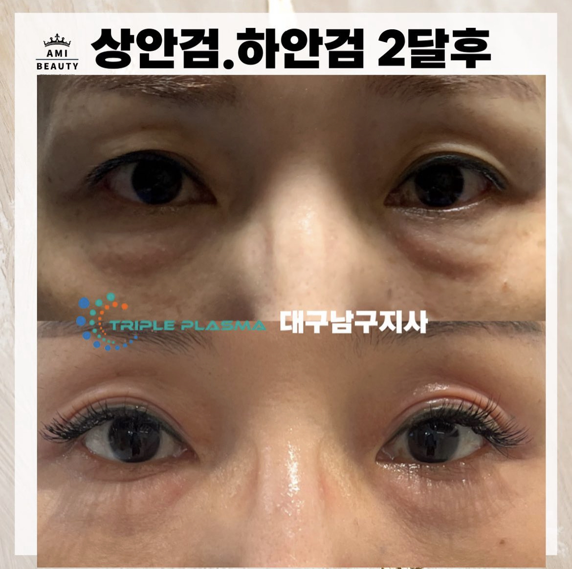 콜드플라즈마지사 아미뷰티 아카데미