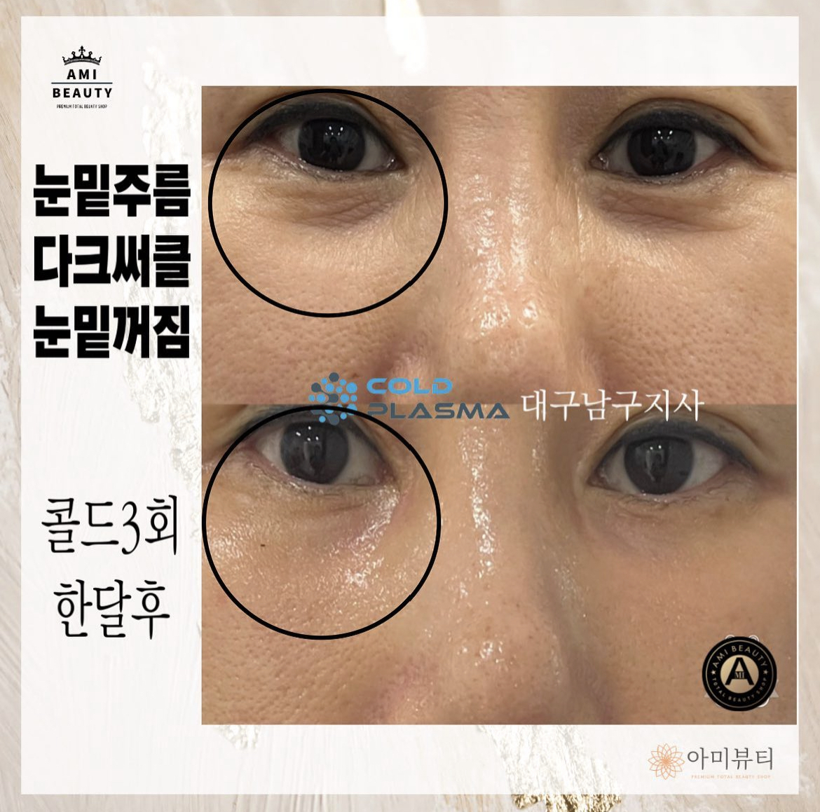 콜드플라즈마지사 아미뷰티 아카데미 대표 이미지