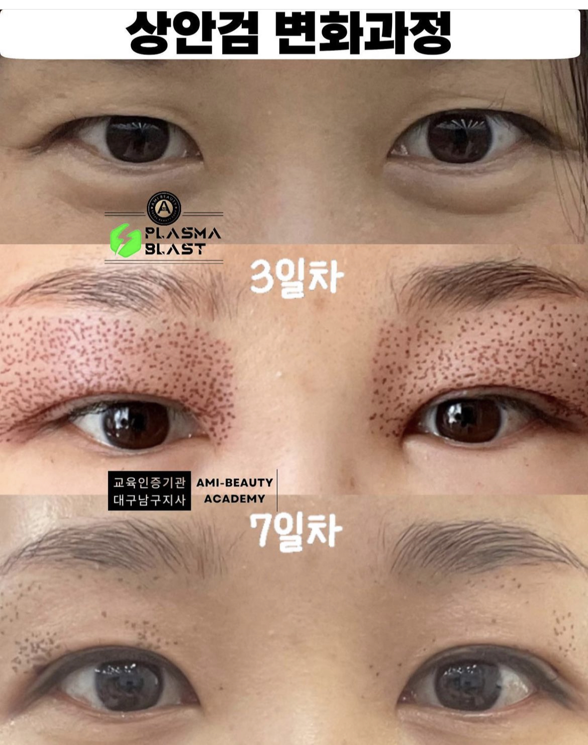 콜드플라즈마지사 아미뷰티 아카데미