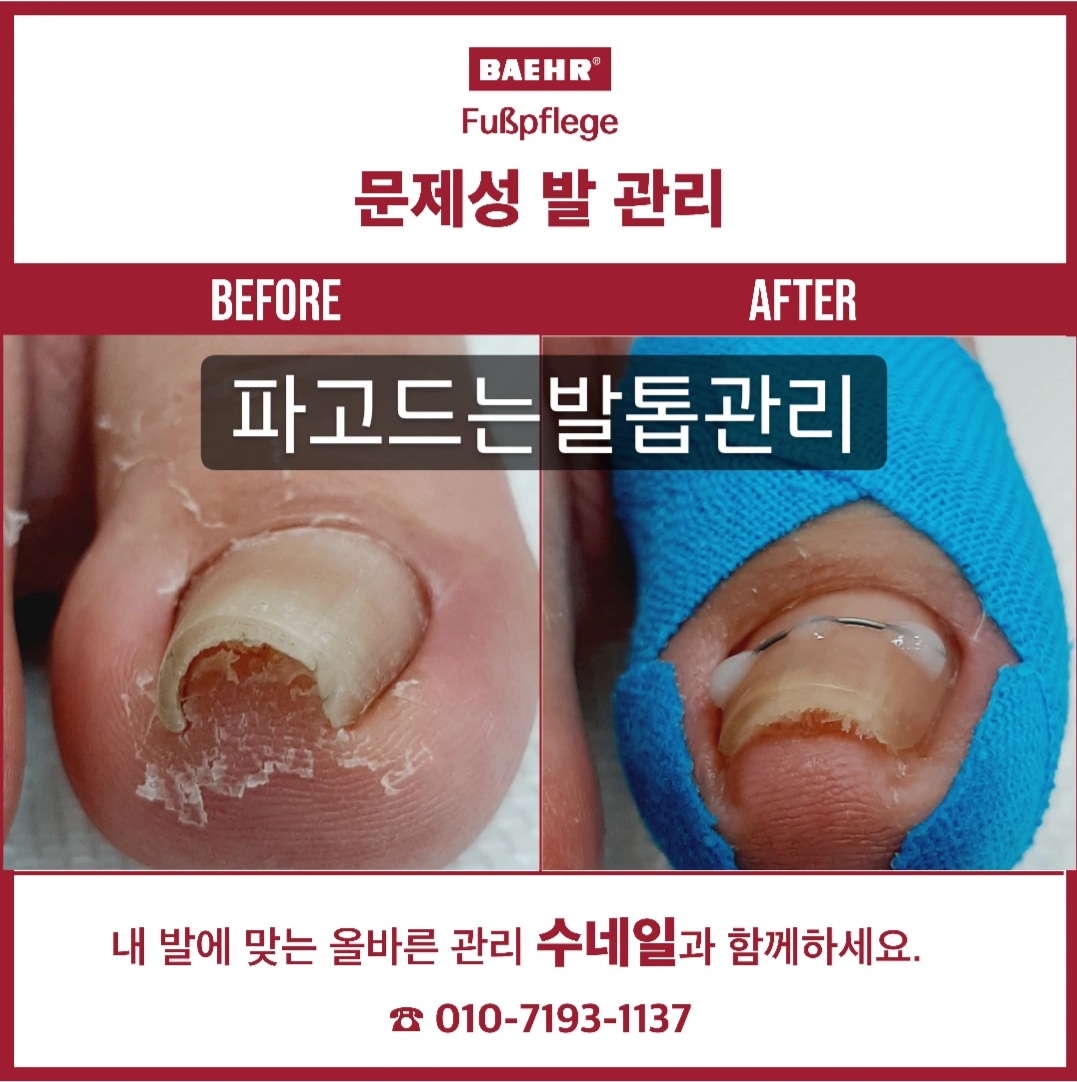 수네일