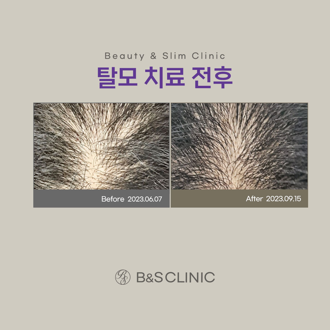 삼성비앤에스의원 강남