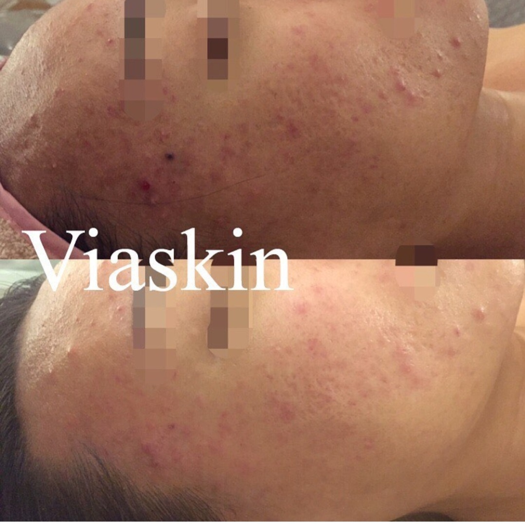 비아스킨 대표 이미지