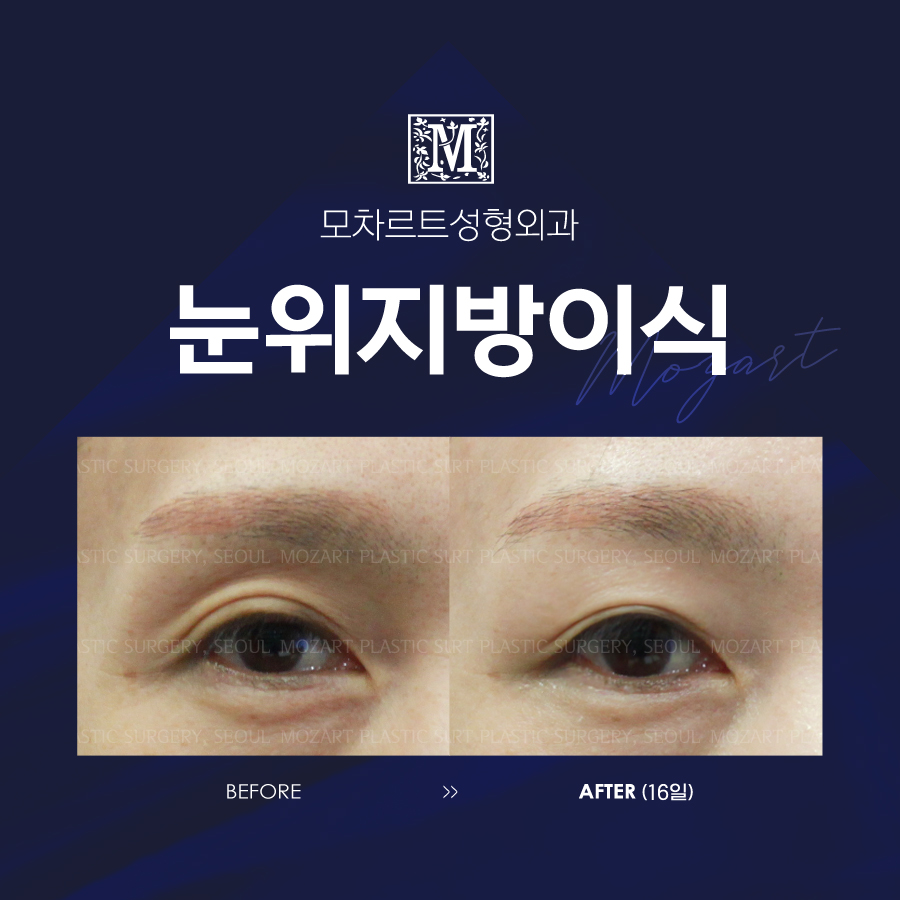 모차르트성형외과