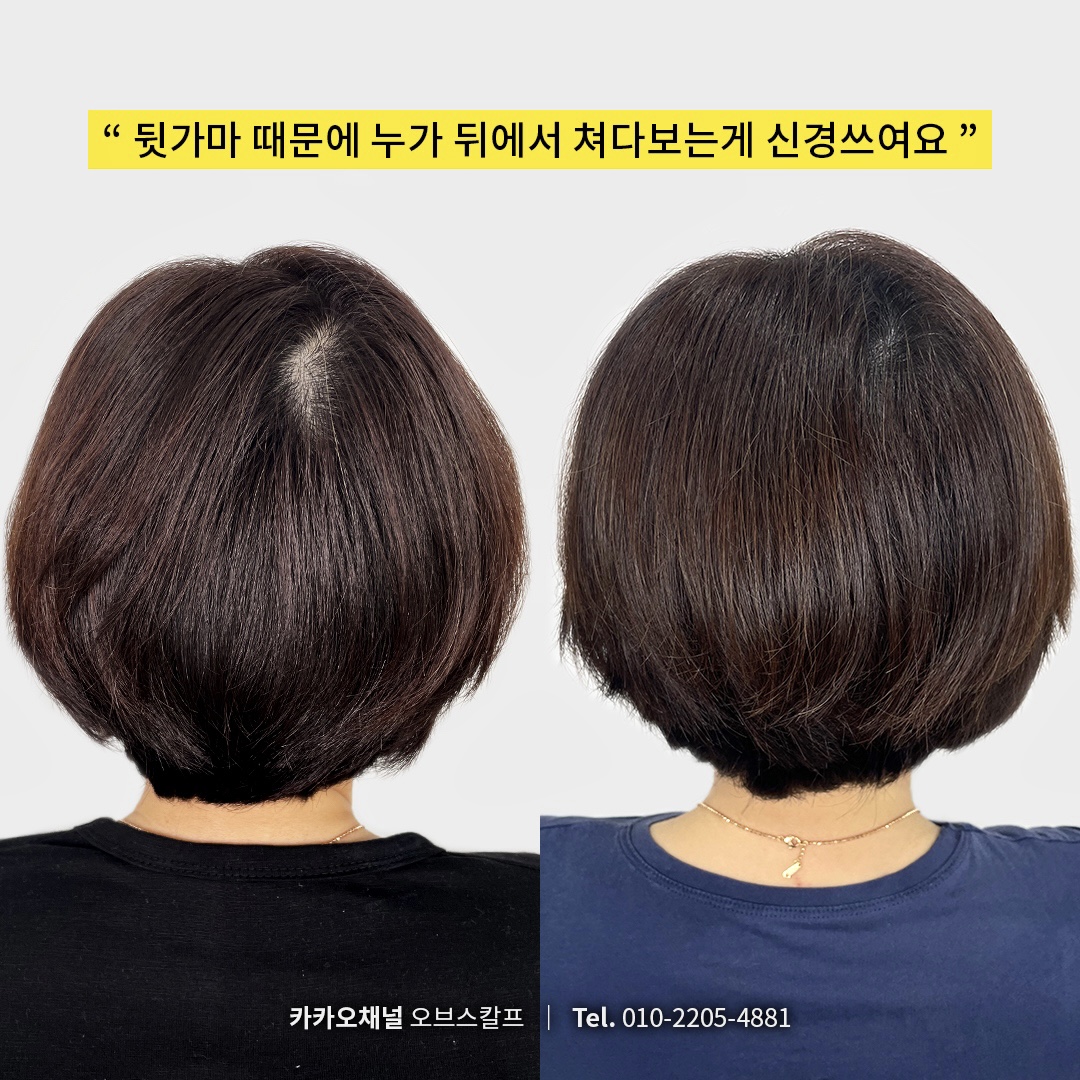 오브스칼프 대표 이미지