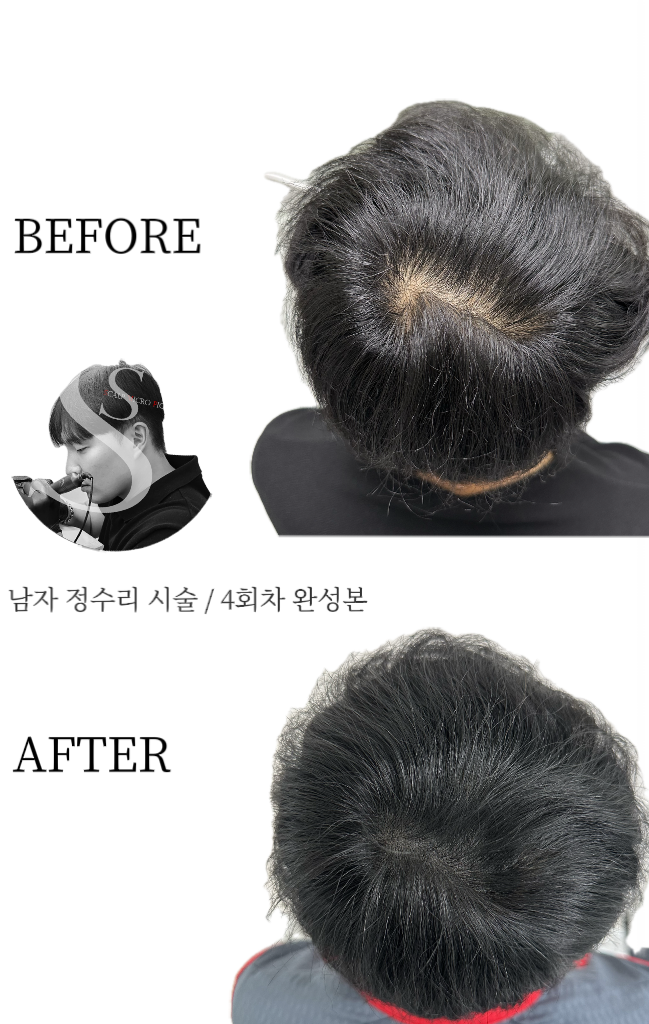 쏭스칼프 탈모 두피커버 전문점