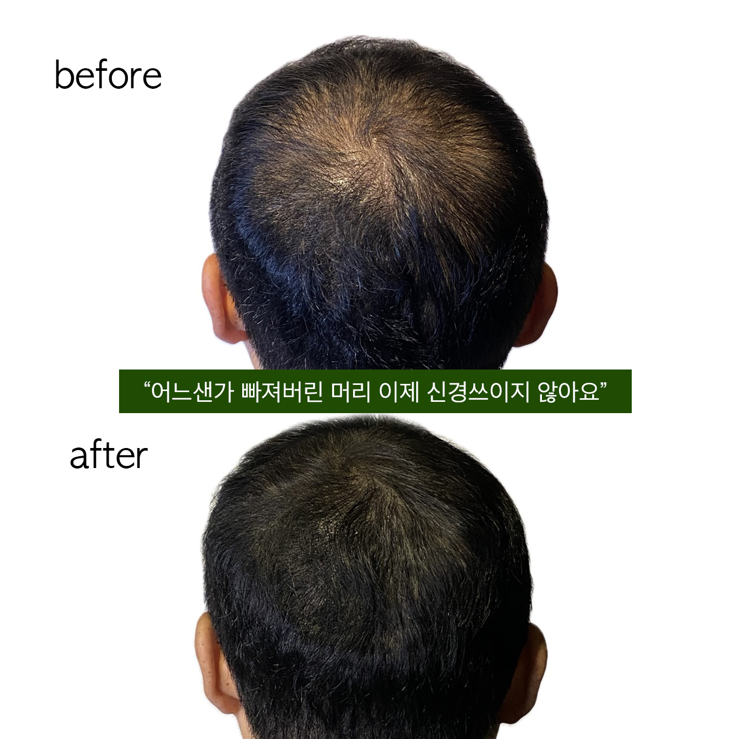 덴시티SMP 두피관리 탈모관리