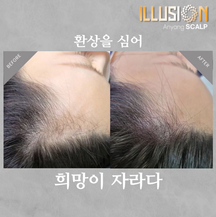 일루젼스칼프 안양점