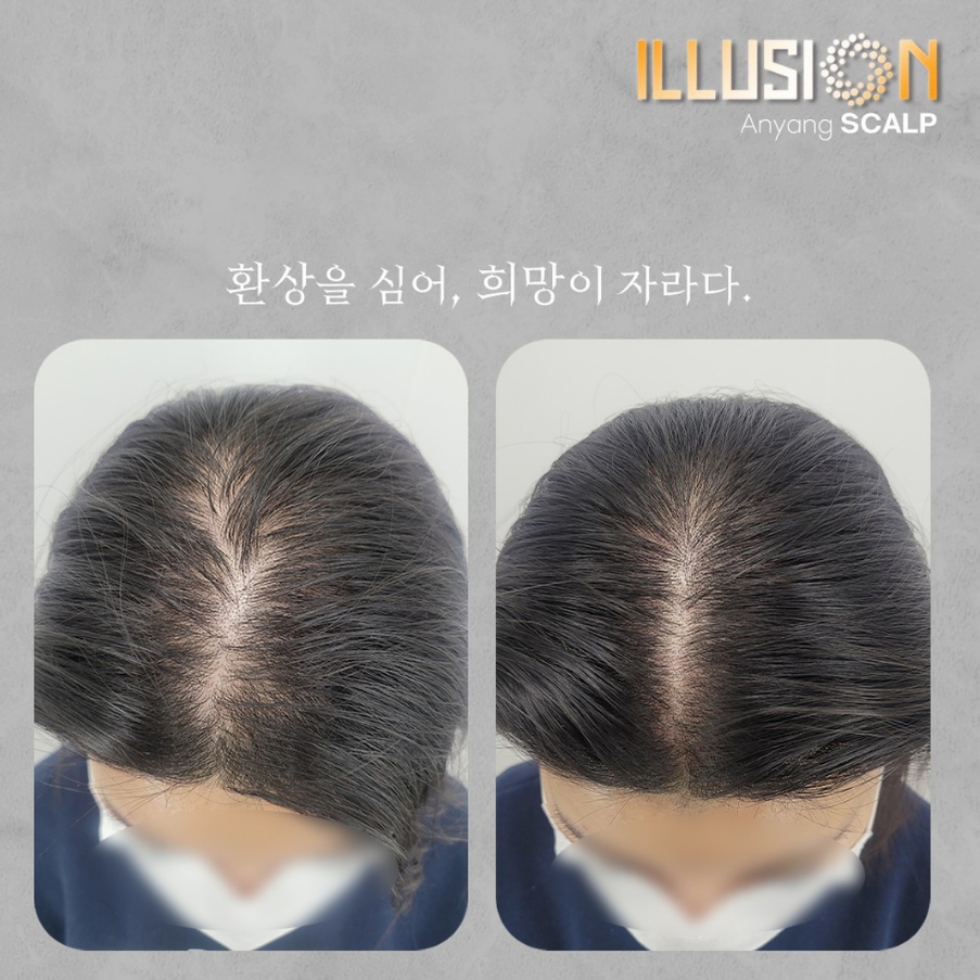 일루젼스칼프 안양점