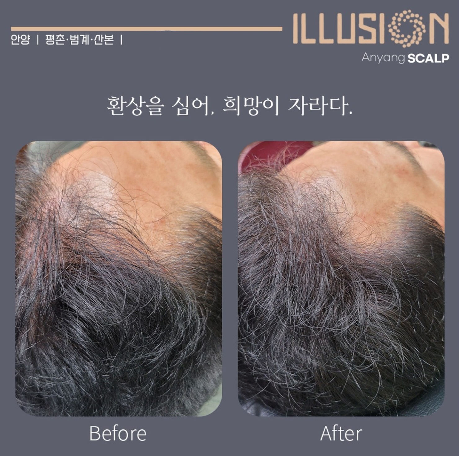 일루젼스칼프 안양점