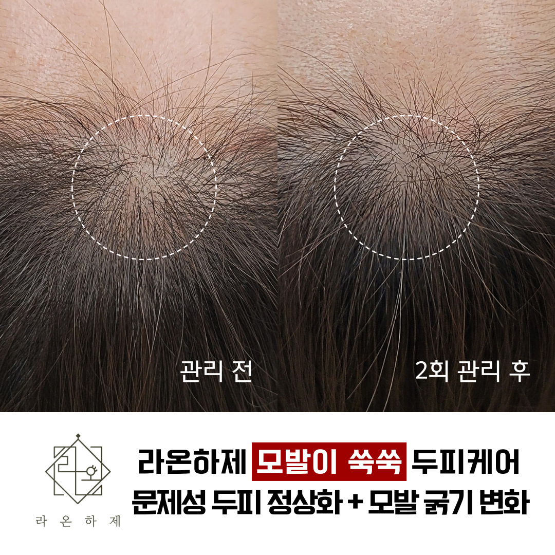 라온하제 두피 탈모케어 눈썹 속눈썹펌 천안본점