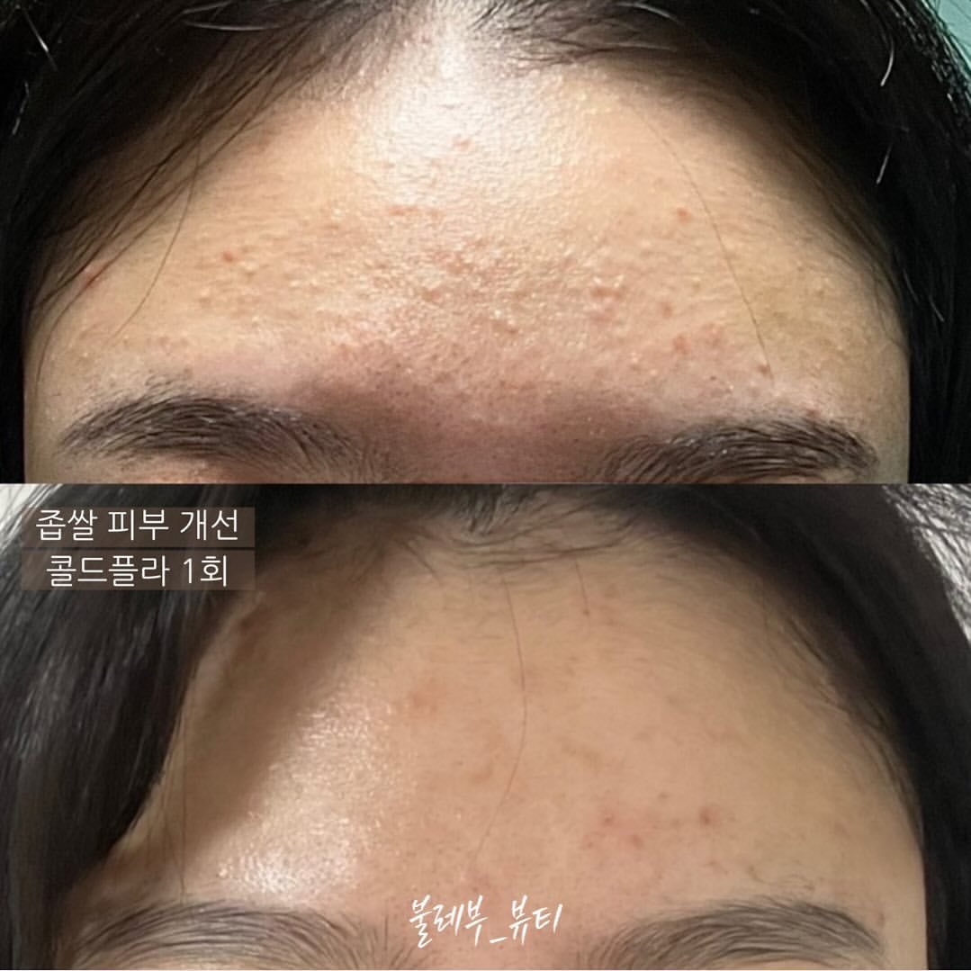 플라즈마불레부뷰티