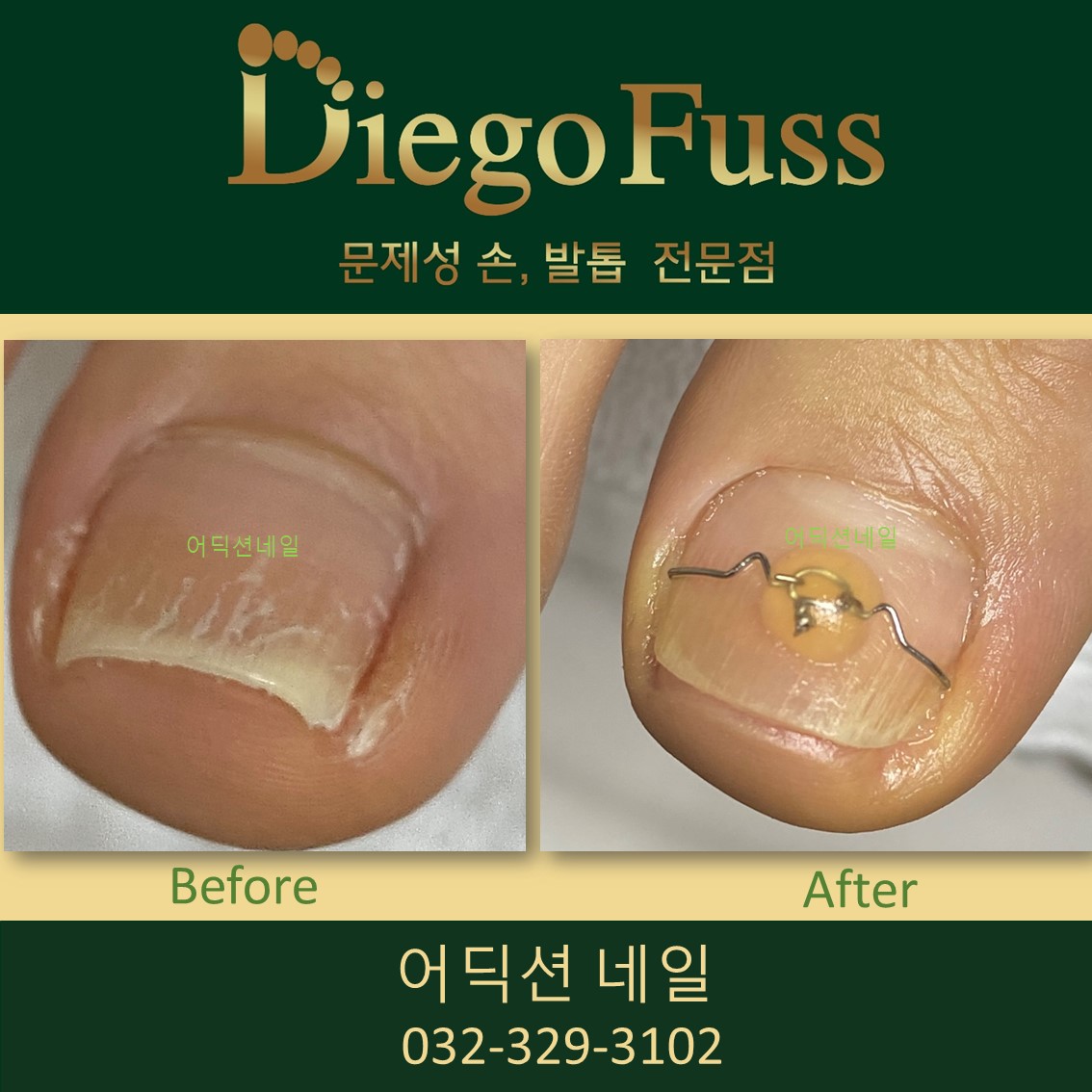 부천디에고푸스본점어딕션네일&풋케어전문