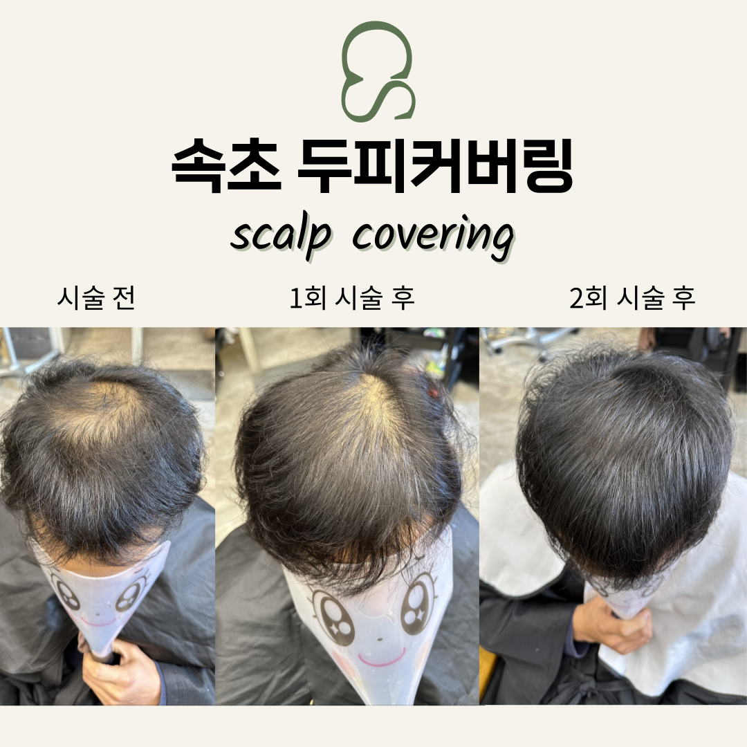 속초두피커버링