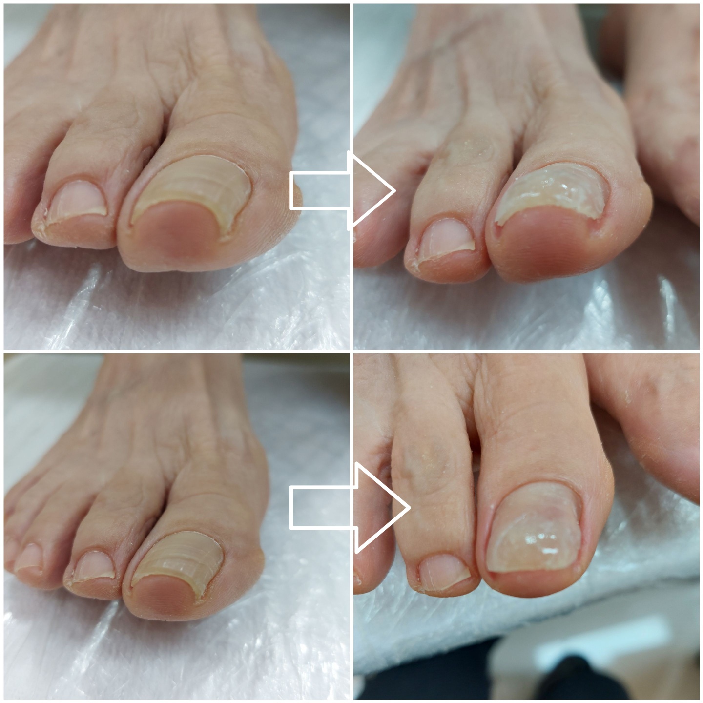 코디풋네일 내성무좀발톱발각질관리