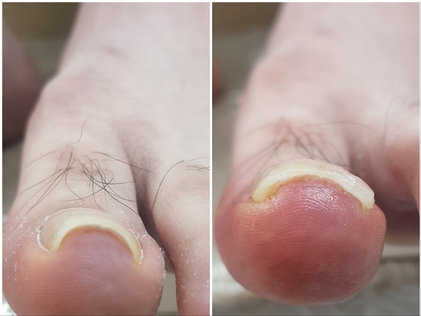 코디풋네일 내성무좀발톱발각질관리