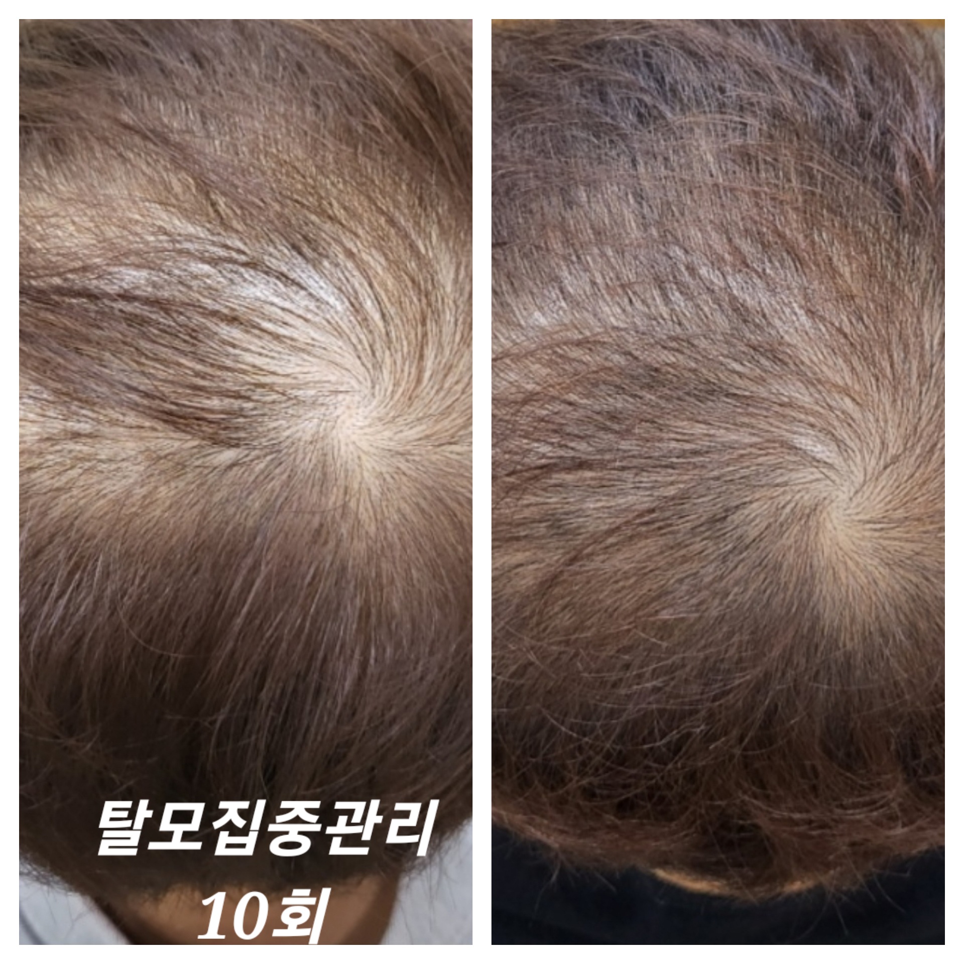 디에이치스킨스칼프