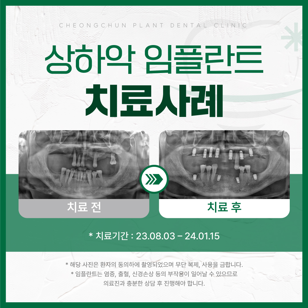 청춘플란트치과의원 춘천 대표 이미지