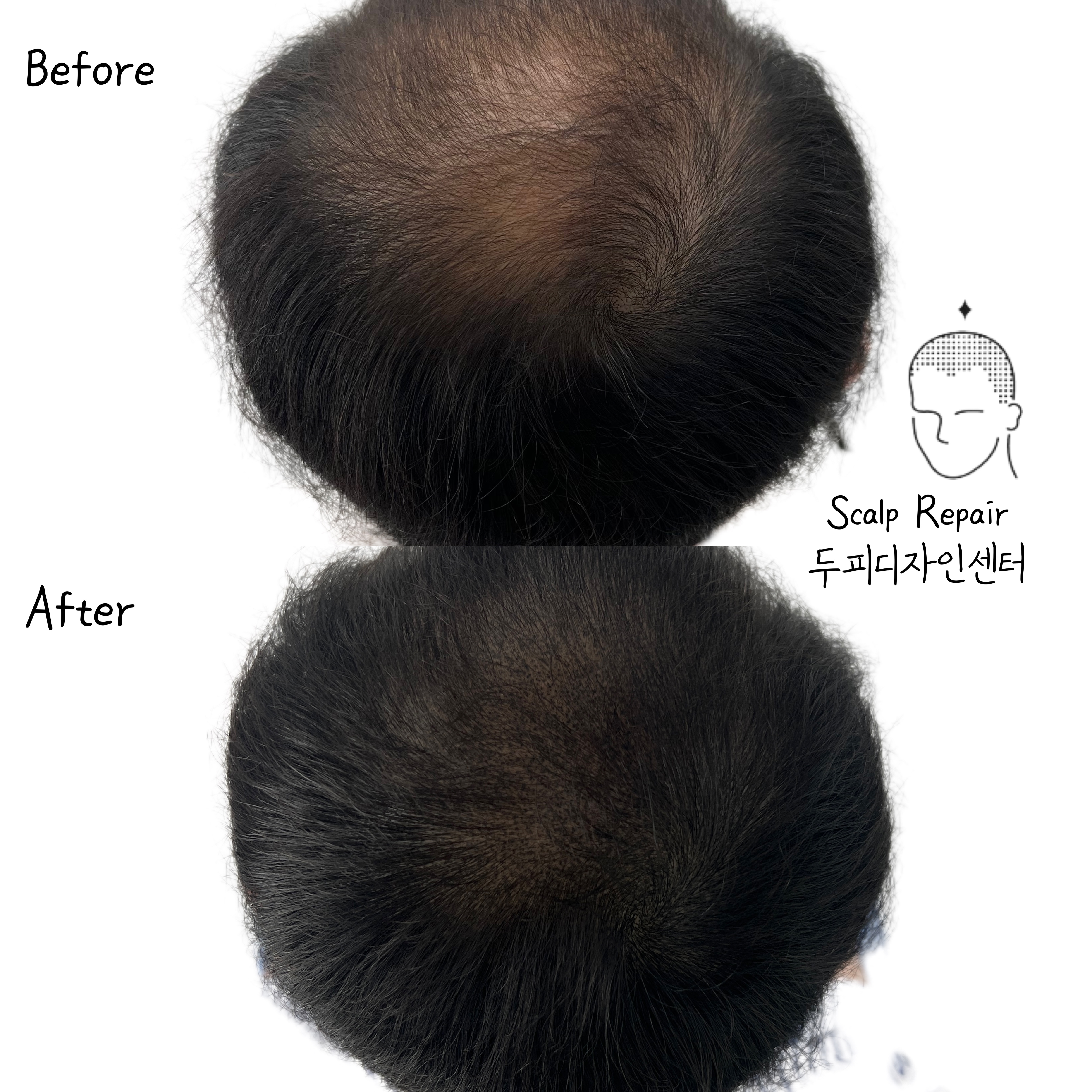 스칼프리페어 두피디자인센터