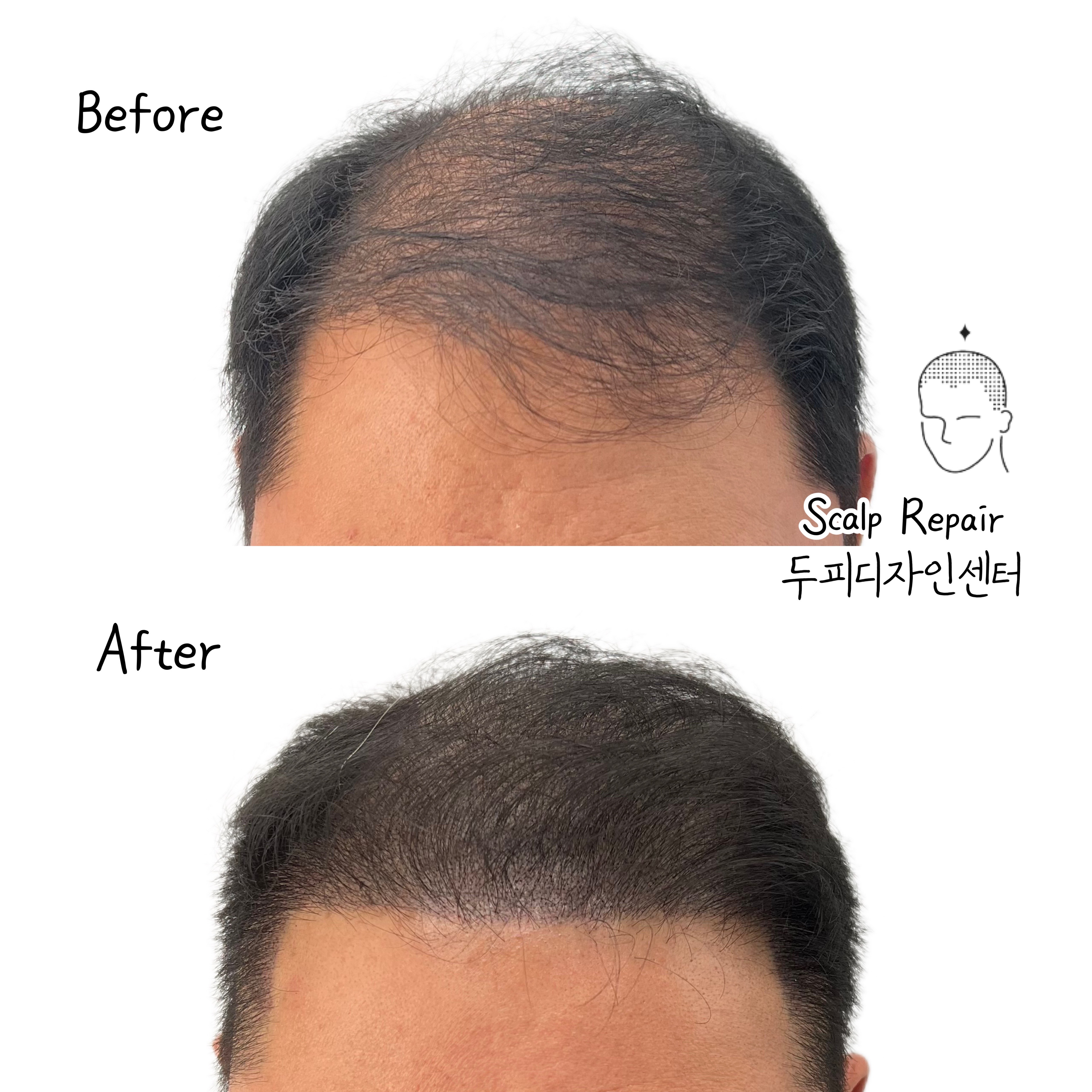 스칼프리페어 두피디자인센터