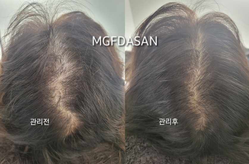엠지에프 두피탈모 전문센터 남양주다산점 대표 이미지