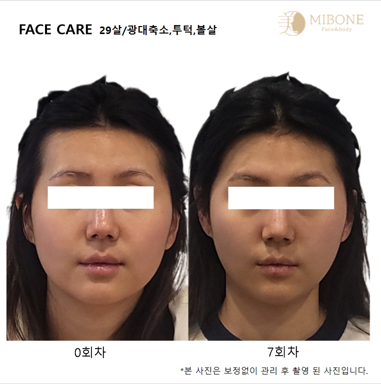 미본 얼굴윤곽관리 대표 이미지
