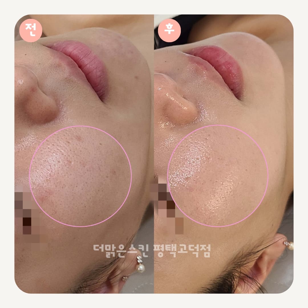 더맑은스킨 평택고덕점
